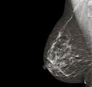Mamografia digital