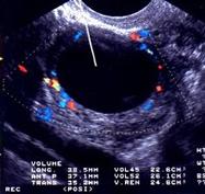 Punção com biopsia dirigida por ultrassom